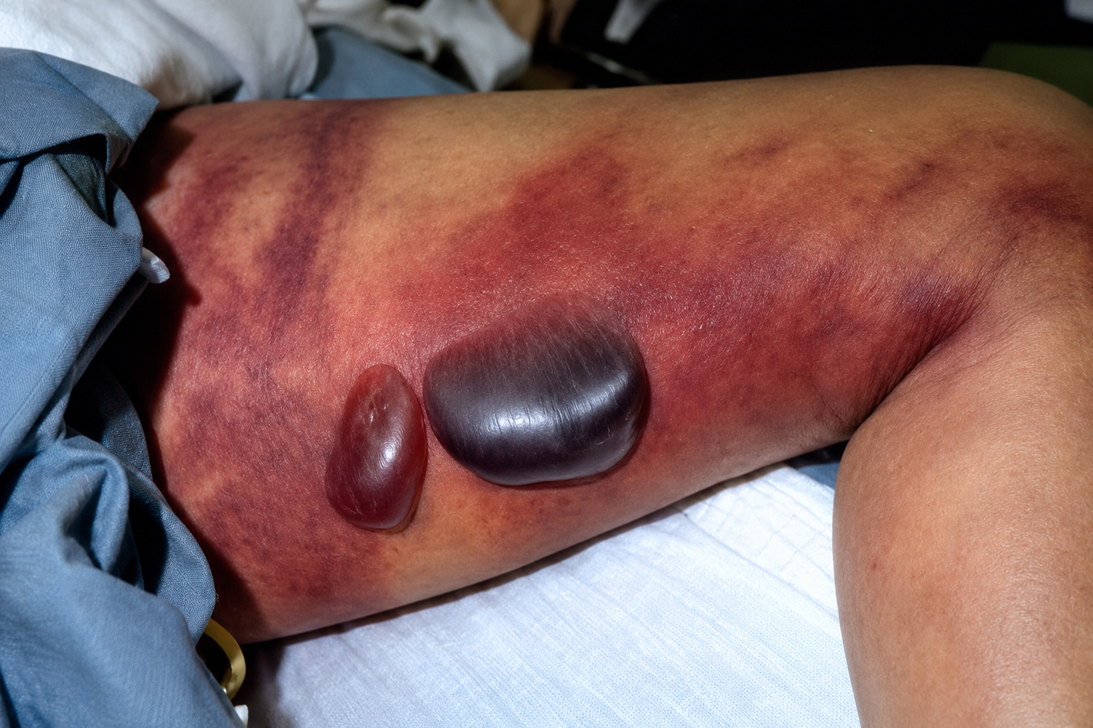 Stage 2 — intermediate: blistering